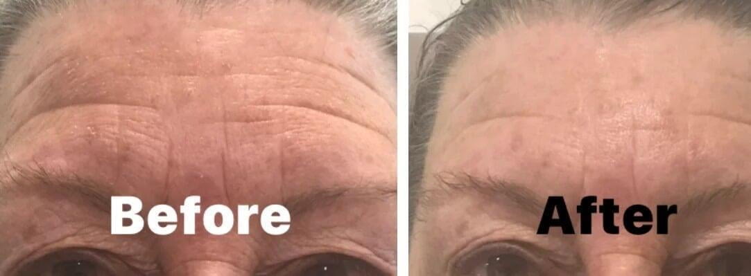 Before and after, forehead lines