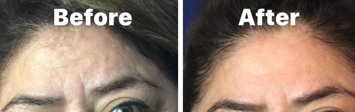 Before and after, forehead
