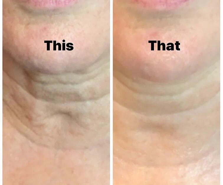 Before and after, neck lines