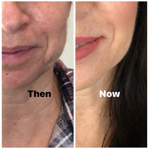 Before and after, lower face and neck